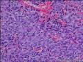 面部肿物，是多形性腺瘤么，有很多血管，请会诊图18