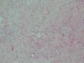 胃窦肿块-上海市骨与软组织肿瘤病理读片2013（3-4）-复旦大学华东医院提供图5