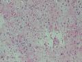 胃窦肿块-上海市骨与软组织肿瘤病理读片2013（3-4）-复旦大学华东医院提供图9