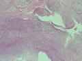 胃窦肿块-上海市骨与软组织肿瘤病理读片2013（3-4）-复旦大学华东医院提供图3