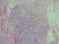胃窦肿块-上海市骨与软组织肿瘤病理读片2013（3-4）-复旦大学华东医院提供图7