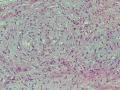 胃窦肿块-上海市骨与软组织肿瘤病理读片2013（3-4）-复旦大学华东医院提供图8