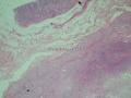 胃窦肿块-上海市骨与软组织肿瘤病理读片2013（3-4）-复旦大学华东医院提供图1