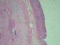 胃窦肿块-上海市骨与软组织肿瘤病理读片2013（3-4）-复旦大学华东医院提供图2