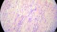 经典病例学习-肾血管平滑肌脂肪瘤图16