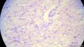 经典病例学习-肾血管平滑肌脂肪瘤图15