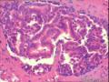 左乳腺纤维腺瘤，部分区域导管内腺体呈普通型增生？图6