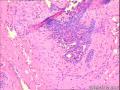 左乳腺纤维腺瘤，部分区域导管内腺体呈普通型增生？图2