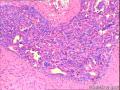 左乳腺纤维腺瘤，部分区域导管内腺体呈普通型增生？图1