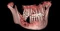 牙龈肿物图2