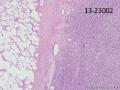 腰背部肿块-上海市骨与软组织肿瘤病理读片2013（3-6）-复旦大学中山医院提供图11