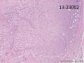 腰背部肿块-上海市骨与软组织肿瘤病理读片2013（3-6）-复旦大学中山医院提供图9
