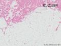 腰背部肿块-上海市骨与软组织肿瘤病理读片2013（3-6）-复旦大学中山医院提供图1