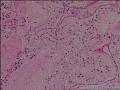 左肾透明细胞癌图5