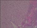 左肾透明细胞癌图3
