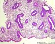 子宫内膜2：够复杂非典型吗？图7