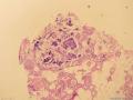 乳腺包块2(已经添加免疫组化图片）图29