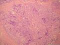 乳腺包块2(已经添加免疫组化图片）图28