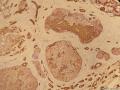 乳腺包块2(已经添加免疫组化图片）图2
