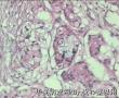 卵巢肿瘤和胃肿瘤图11