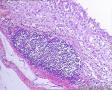 卵巢畸胎瘤图15