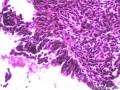 卵巢囊性肿瘤图16