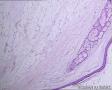 卵巢畸胎瘤图17