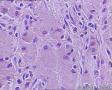 卵巢畸胎瘤图10