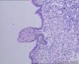 卵巢畸胎瘤图2