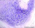 卵巢畸胎瘤图16
