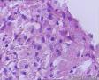 卵巢畸胎瘤图14