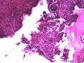 卵巢囊性肿瘤图11