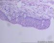 卵巢畸胎瘤图5