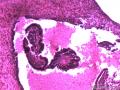 卵巢囊性肿瘤图8