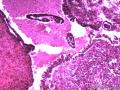 卵巢囊性肿瘤图10