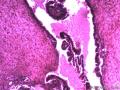 卵巢囊性肿瘤图4