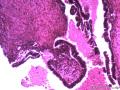卵巢囊性肿瘤图5