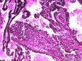 卵巢囊性肿瘤图12
