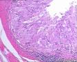 卵巢畸胎瘤图11