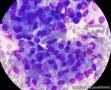 胸水，间皮细胞还是癌细胞？图9