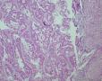 子宫中分化内膜样腺癌，是否合并粘液腺癌成分？图3