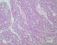 子宫中分化内膜样腺癌，是否合并粘液腺癌成分？图7