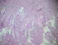 子宫中分化内膜样腺癌，是否合并粘液腺癌成分？图2