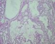 子宫中分化内膜样腺癌，是否合并粘液腺癌成分？图9
