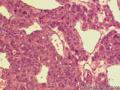 甲状腺包膜完整肿块，核分裂相多见，如何诊断？图25