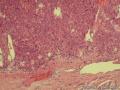 甲状腺包膜完整肿块，核分裂相多见，如何诊断？图9