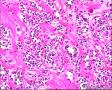 2014年第17期（总第96期）——子宫肌壁肿物图4