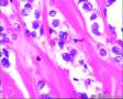 2014年第17期（总第96期）——子宫肌壁肿物图16