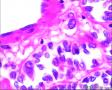 2014年第17期（总第96期）——子宫肌壁肿物图17