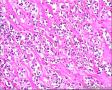 2014年第17期（总第96期）——子宫肌壁肿物图3